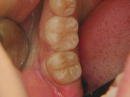 虫歯の治療後